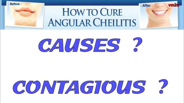 How To Cure Angular Cheilitis Symptoms With Angular Cheilitis Cream Treatment смотреть онлайн