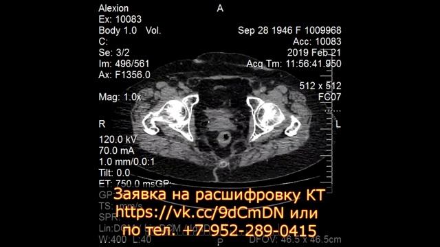 Множественные кисты в почках после пересмотра диска КТ урографии с контрастированием смотреть онлайн