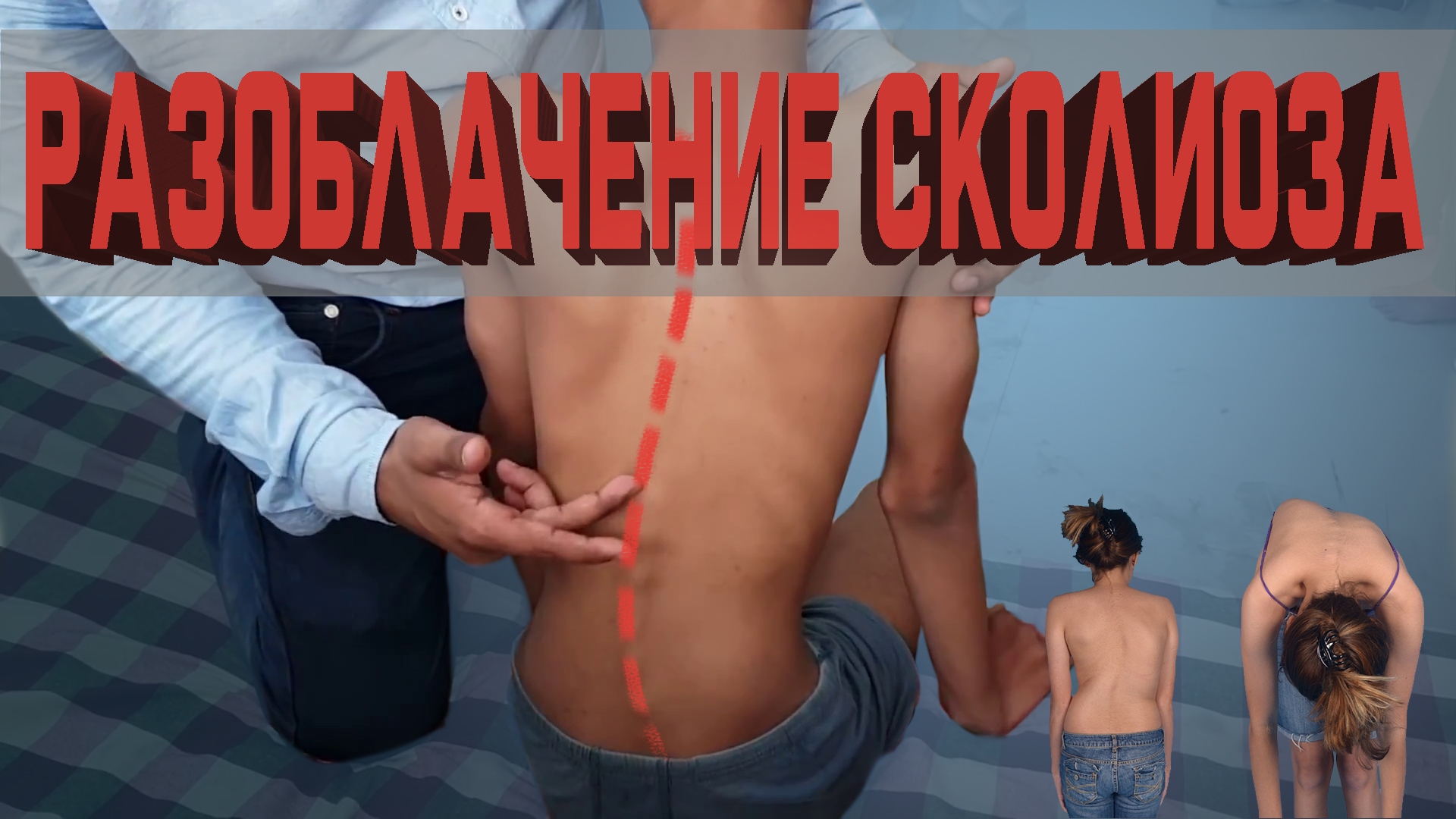 Что такое сколиоз? смотреть онлайн