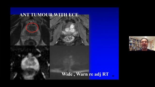 MRI - What The Urologist Needs смотреть онлайн