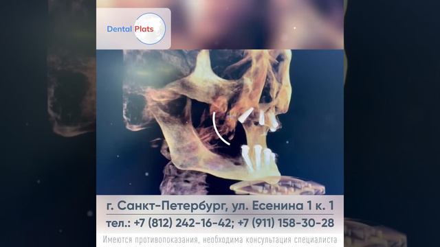 Имплантация по методике All On 4, два пациента