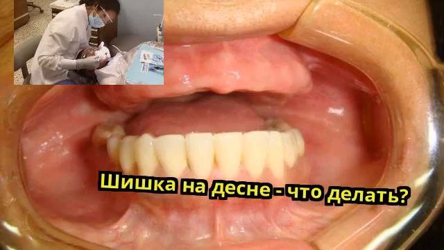Шишка на десне - что делать? смотреть онлайн