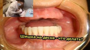 Шишка на десне - что делать?