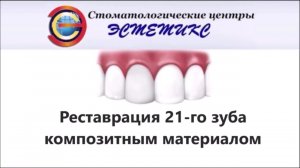 Реставрация 21 го зуба композитным материалом
