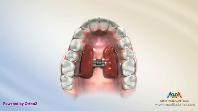 Orthodontic Treatment for Narrow Upper Jaw with Functional Shift - Expander or Spacer смотреть онлайн