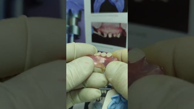 нейлоновый протез смотреть онлайн