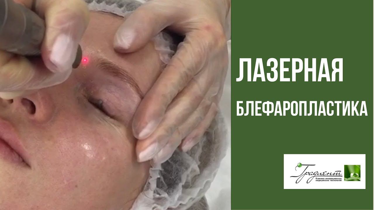 ЛАЗЕРНАЯ БЛЕФАРОПЛАСТИКА Fotona - проведение процедуры в клинике косметологии "Градиент" смотреть онлайн