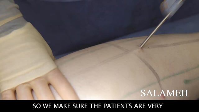 Lower Leg Lipedema HD Liposuction - Procedure Pt. 2  Salameh