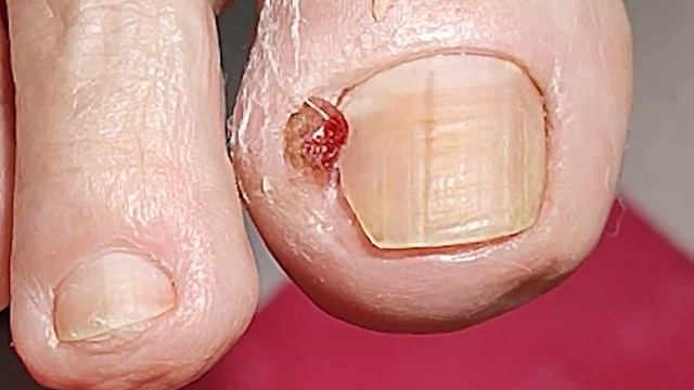 OVERGROWN INFECTED INGROWN TOENAIL REMOVAL (PODOLOGIA EM UNHA ENCRAVADA)