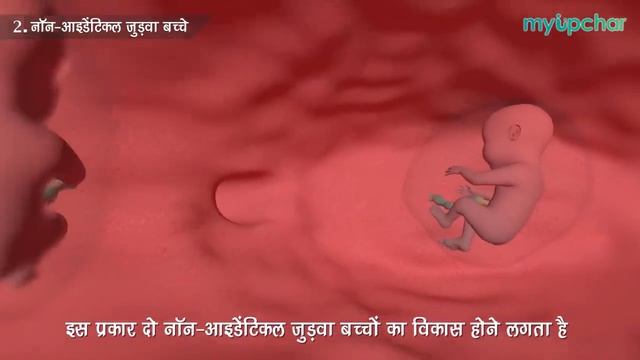 जुड़वा बच्चे क्यों, कैसे और कब पैदा होते हैं, 3D में देखें - Twins pregnancy in hindi by Dr. Archan смотреть онлайн