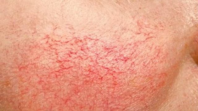 Купероз на лице смотреть онлайн