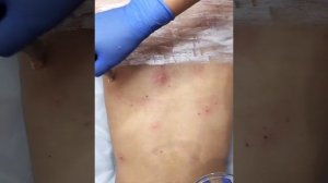 Чистка спины в Центре эстетики «Идеаль»