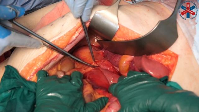 Kocher manoeuvre - exposure of retroperitoneum and aorta смотреть онлайн