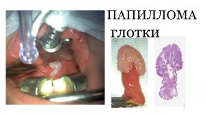 ПАПИЛЛОМА ГЛОТКИ / НОВООБРАЗОВАНИЕ ГЛОТКИ / УДАЛЕНИЕ НОВООБРАЗОВАНИЯ ГЛОТКИ