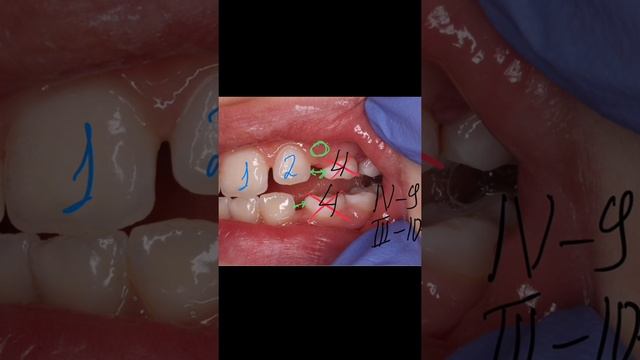 Зуб растет вторым рядом. Что делать? смотреть онлайн