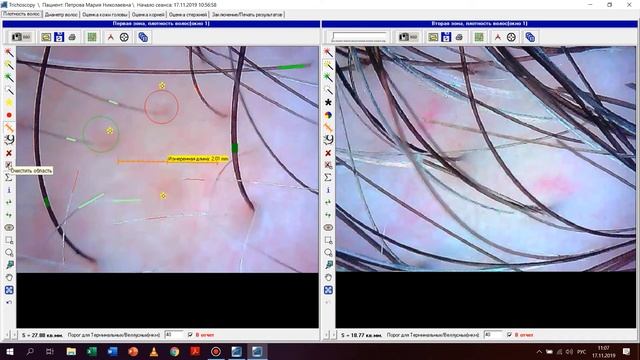 Трихоскопия в программе TrichoScience C новым модулем для ASW
