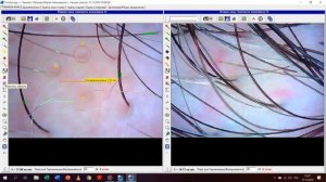 Трихоскопия в программе TrichoScience c новым модулем для ASW
