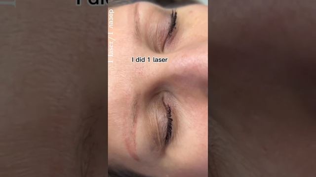 Удаление татуажа бровей ремувером #брови #татуаж #удалениетатуажа #татуажбровей #перманентныймакияж смотреть онлайн