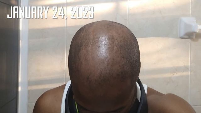 Derma Rolling for Hair Regrowth 2 Year Time Lapse - Unseen Unedited Progress Photos 📸💇♂️ смотреть онлайн