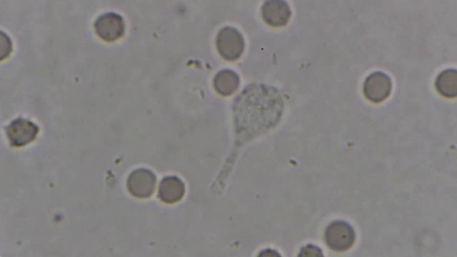 Leukocytes Attacked By Intracellular Parasites. Лейкоциты атакованные внутриклеточными паразитами.