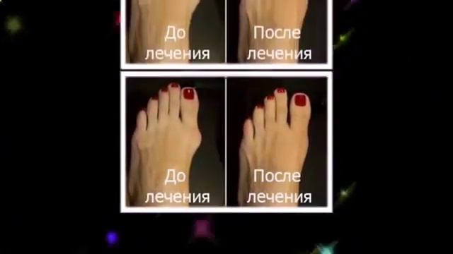 воспаление косточки на ноге смотреть онлайн
