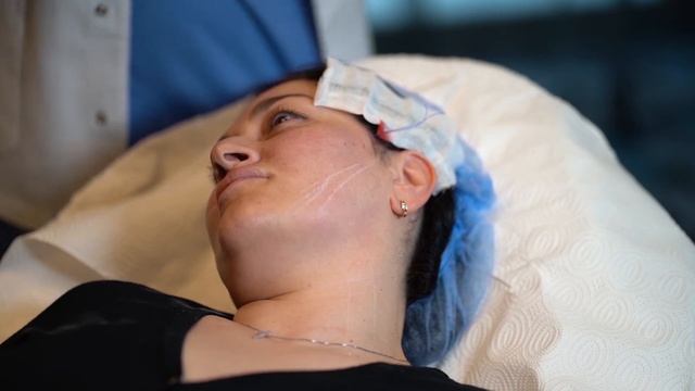 მეზოძაფების გამოყენებით სახის შუა და ქვედ მესამედის რემოდელირება - პრაქტიკული ნაწილი смотреть онлайн