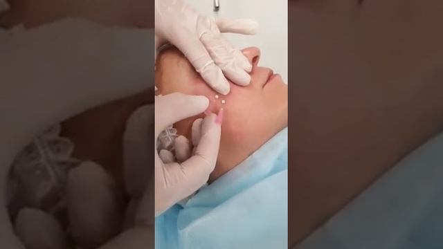 Delicate Thread: омоложение периорбитальной зоны. "Деликатные" нити для деликатных зон смотреть онлайн