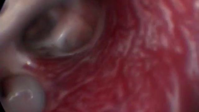 Трахеоскопия у птицы. Венозный рисунок в подслизистом слое. смотреть онлайн