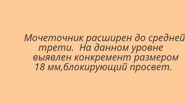 Конкремент в мочеточнике(уретеролитиаз) смотреть онлайн