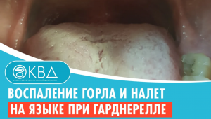 ? Воспаление горла и налет на языке при гарднерелле. Клинический случай №928
