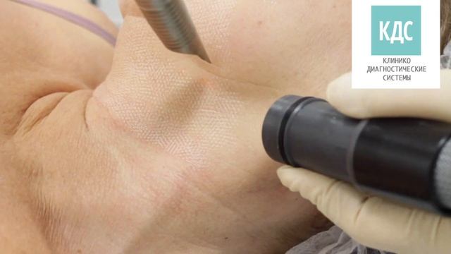 Фракционная лазерная шлифовка поверхности кожи смотреть онлайн