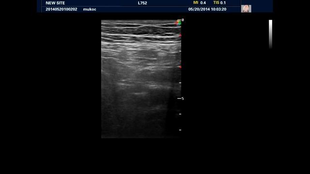 Мукоцеле аппендикса. Mucocele of the appendix смотреть онлайн