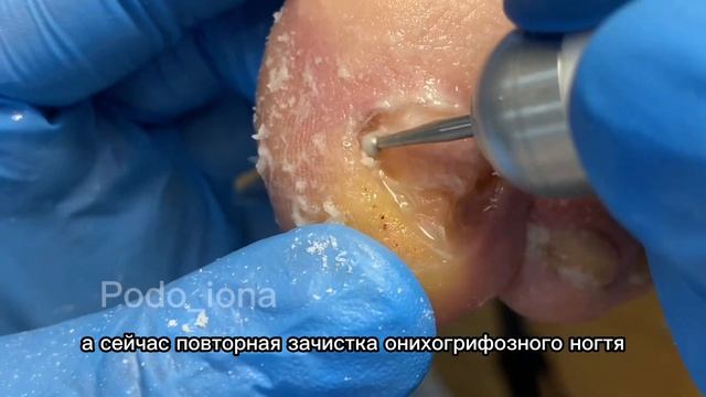 Повторная зачистка онихогрифоза.  #подология #подологмосква #курсыпедикюра #грибок #грибокногтей