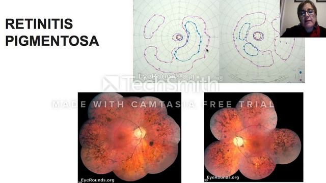distrofies de retina en nens смотреть онлайн
