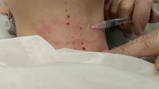 Биоревитализация шеи в клинике 