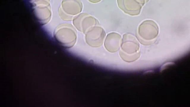 Мельтешащая черточка в крови... Что это? смотреть онлайн