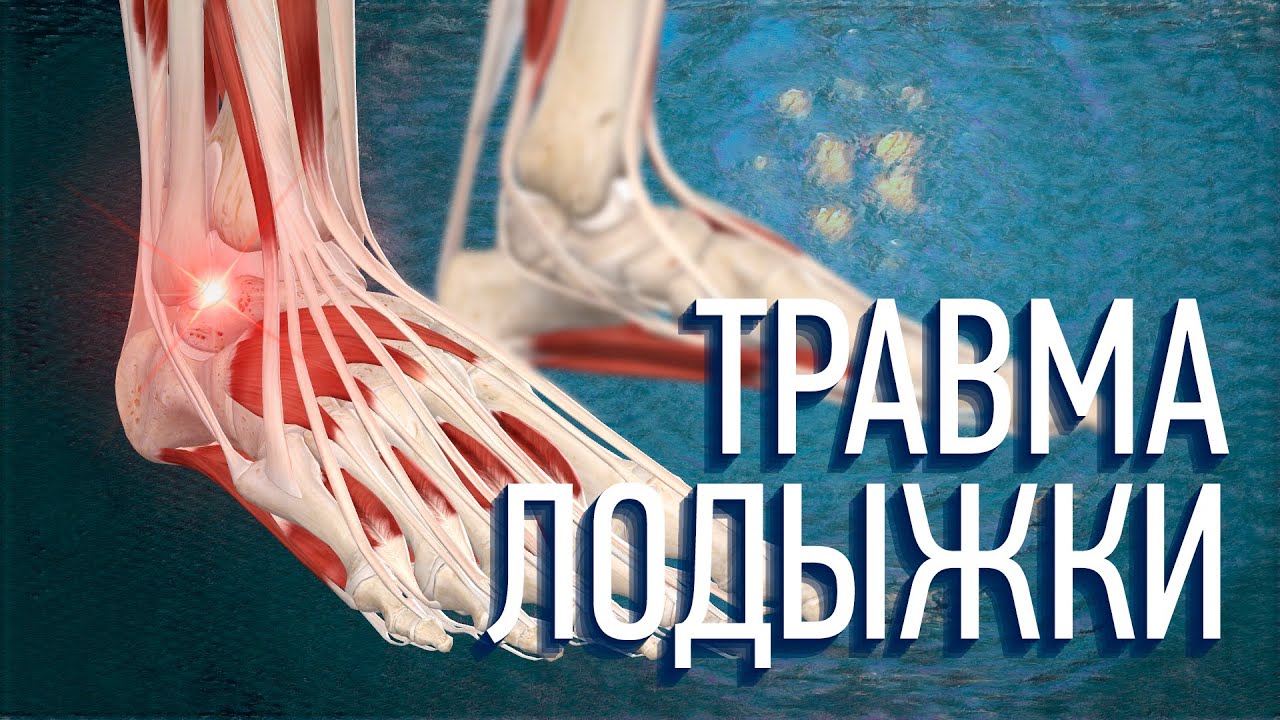 Растяжение лодыжки. Какие упражнения делать? Как восстанавливаться? смотреть онлайн