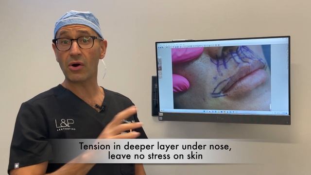 Lip Lift, Corner Lip Lift - Bay Area Plastic Surgeon - How To Get The Best Result For Any Lip Shape