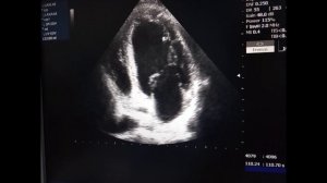 Фракция выброса по Симпсону