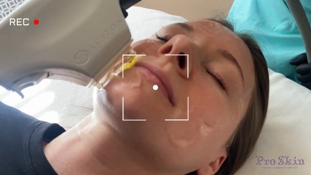 Фотоомоложение BBL