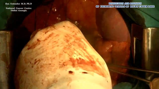 Open Right Upper Lobectomy with Mediastinal Lymphadenectomy for Lung Cancer (NSLC) смотреть онлайн