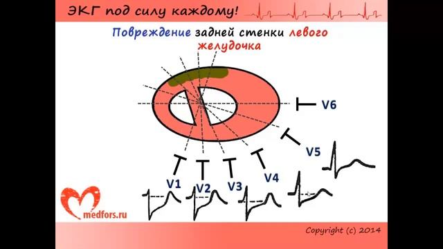 Урок 10 Видеокурс ЭКГ под силу каждому смотреть онлайн