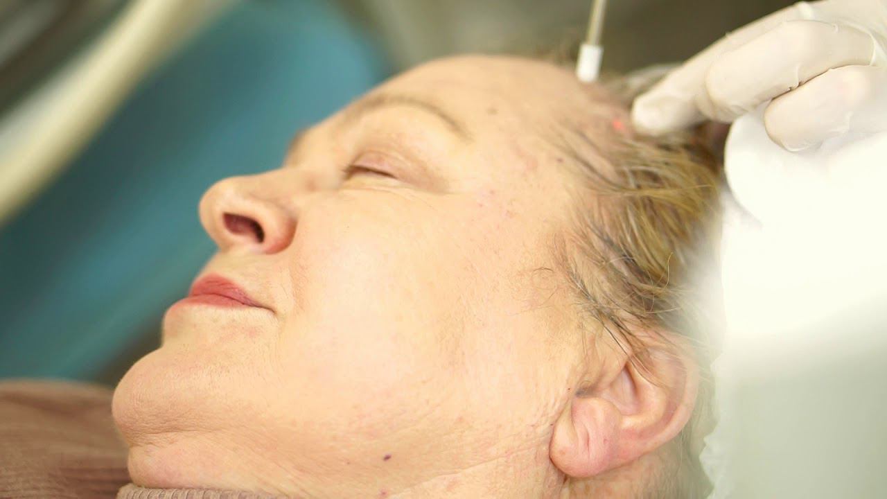 Лазерное удаление новообразований. смотреть онлайн