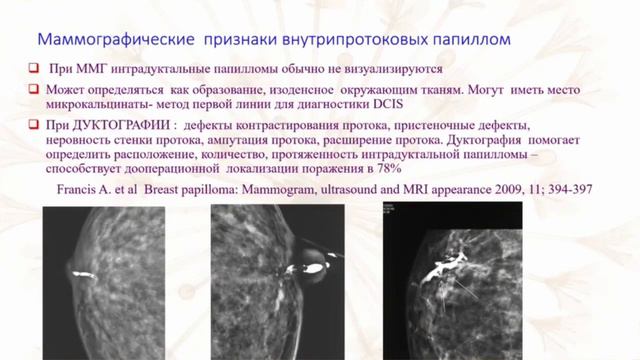 Комплексная лучевая диагностика внутрипротоковых папиллом смотреть онлайн