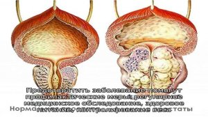 Вакуумные банки при аденоме