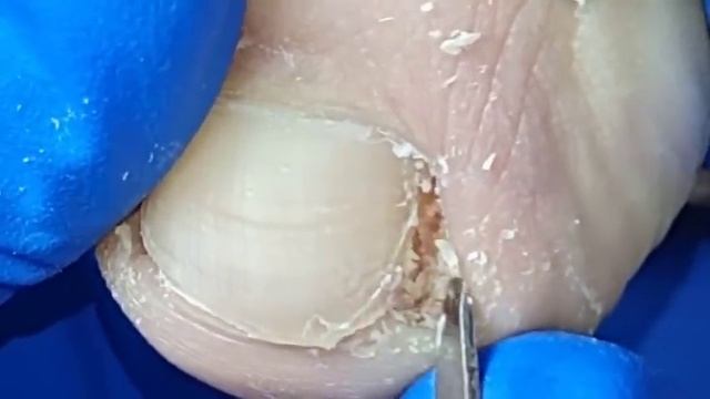 Short nails trim their ingrown nails! Professional pedicure【Xue Yidao】 смотреть онлайн