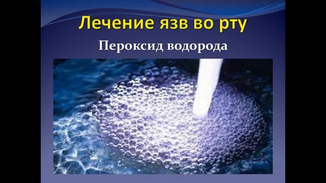 ЛЕЧЕНИЕ ЯЗВ ВО РТУ смотреть онлайн