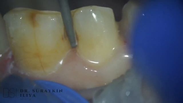 Teeth prep for emax , dental , dentist , dentistry , препарирований зуба под коронку , имплантация смотреть онлайн