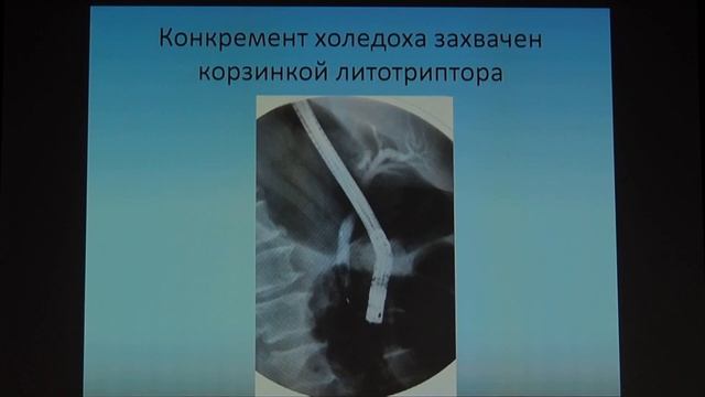 25 Богданов АП – Холедохолитиаз в сочетании с сужением терминального отдела холедоха смотреть онлайн