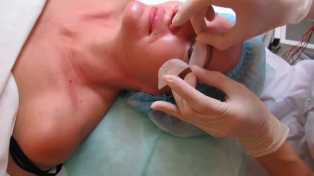 КАРБОКСИТЕРАПИЯ ЛИЦА + МИКРОТОКИ смотреть онлайн